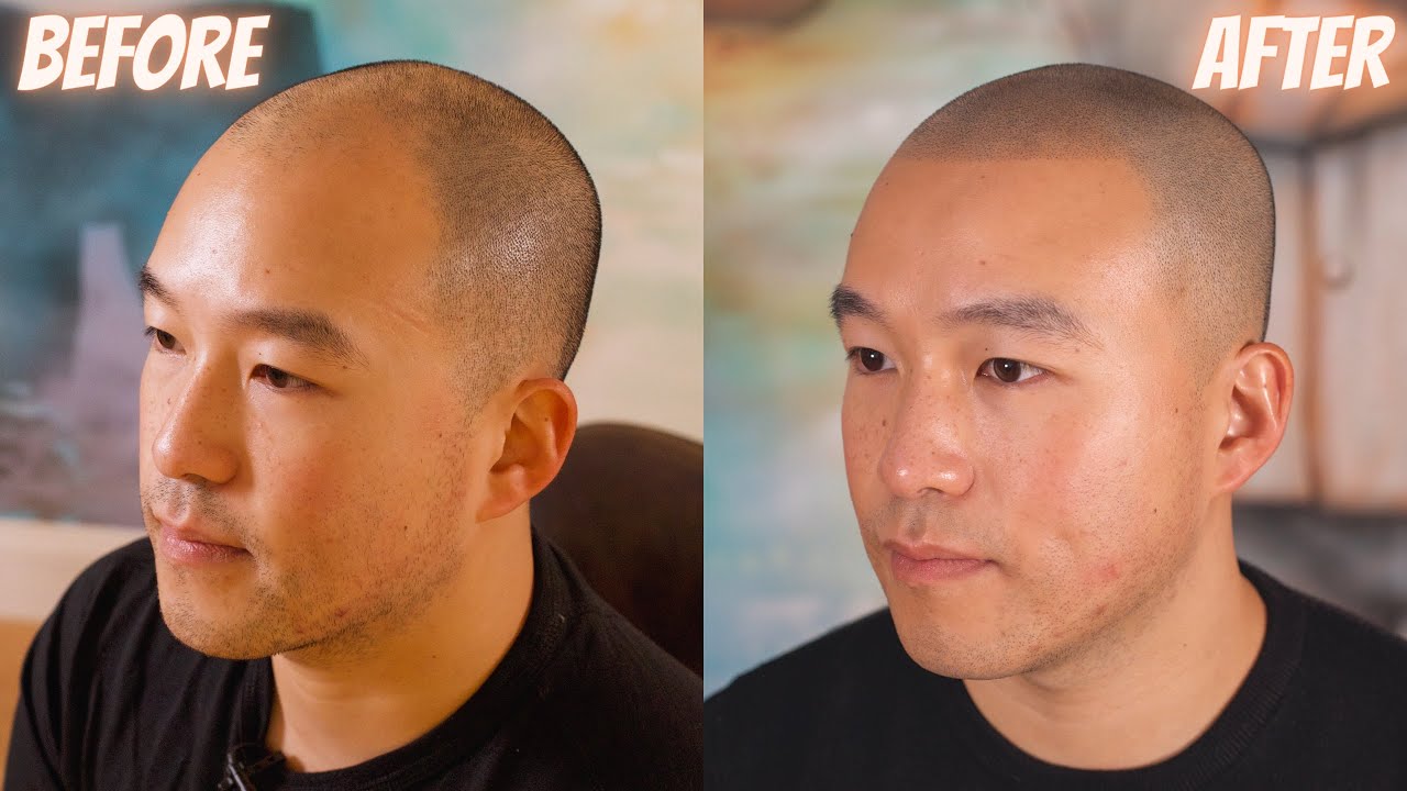 How to treat hair loss with Scalp Micropigmentation? 